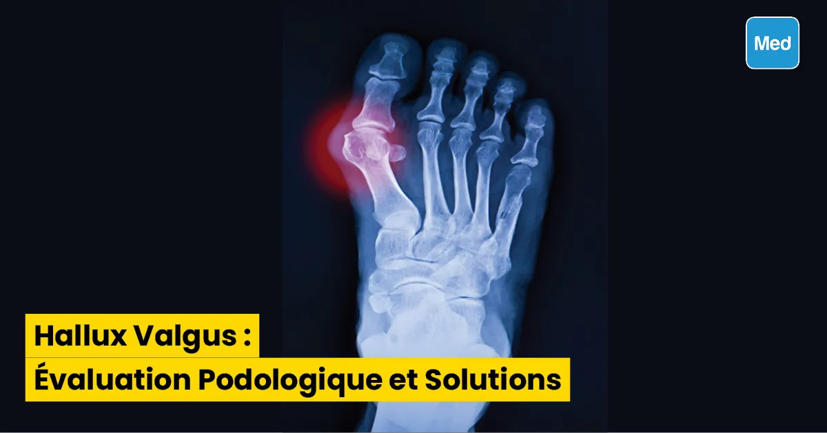 Hallux Valgus : Évaluation Podologique et Solutions